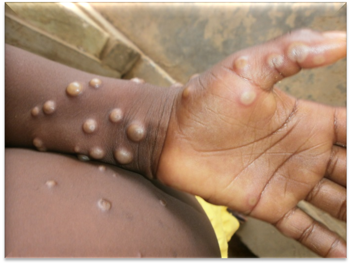 Mpox Outbreak: Understanding the Risks, Facts and Precautions